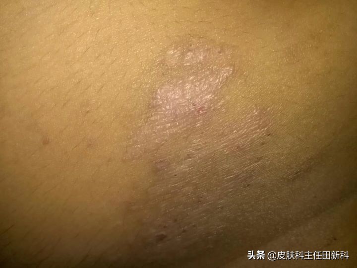 真菌感染性皮肤病原因,人真菌皮肤病怎么治