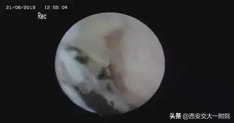 中老年骨性膝关节炎的最好治疗,骨关节是中老年残疾第一大杀手