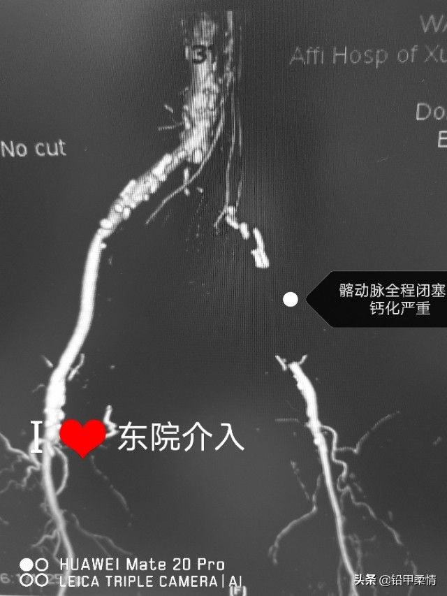 治疗髂总动脉起始端闭塞的专家,年轻人髂动脉闭塞怎么治疗