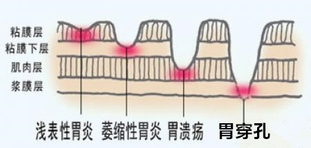 慢性浅表性胃炎怎么能彻底治愈,慢性浅表性胃炎有谁治好了