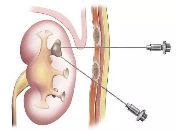 如果得了结石病你要关注哪些,结石感觉快要发作了怎么缓解