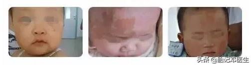 诊治咖啡斑你选对技术了吗,咖啡斑有药可治吗