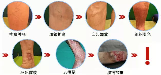 得了难看又难受的下肢静脉曲张，您可以试试这种神奇的疗法！