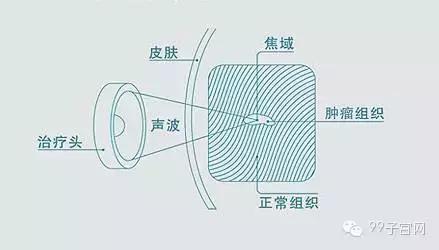 海扶刀是什么病的手术,海扶刀治疗哪些疾病