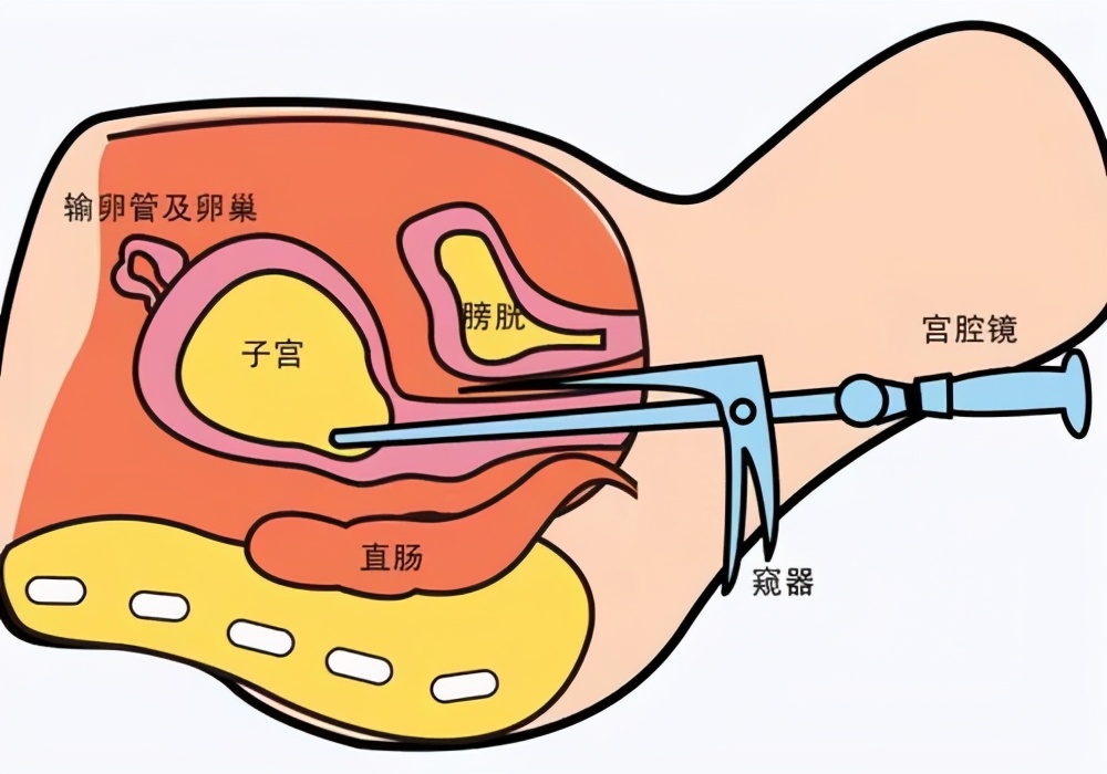 子宫内膜长息肉应怎么治疗,子宫内膜有息肉又怀孕怎么办