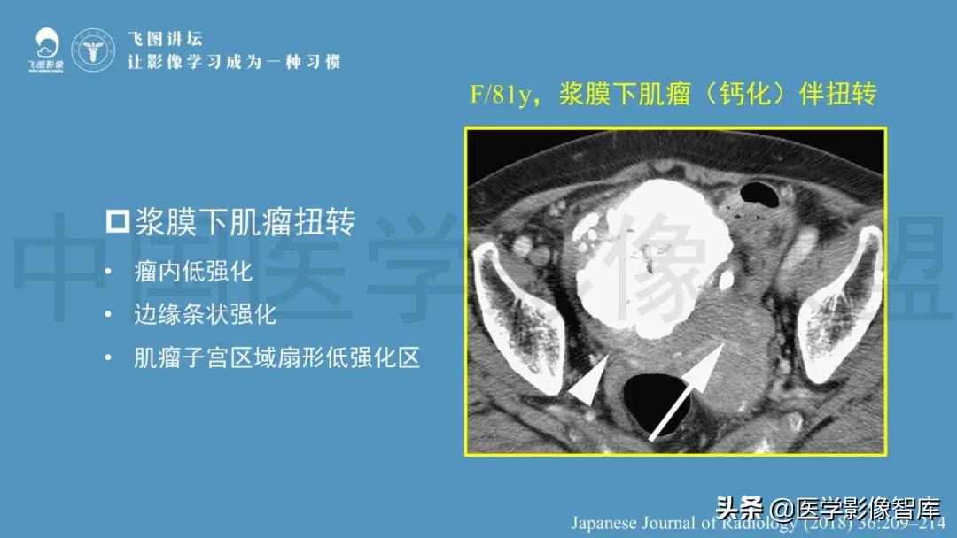 子宫解剖结构输卵管和卵巢位置,子宫附件ct影像学正常解剖表现