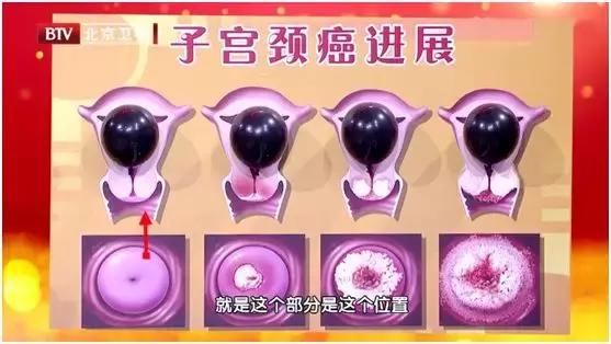 专家教你怎么预防宫颈癌,专家讲如何预防宫颈癌