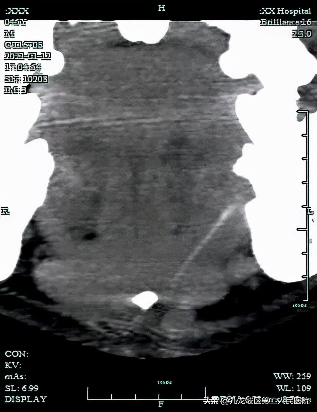 你没看错！下巴脓肿，就是要治牙齿