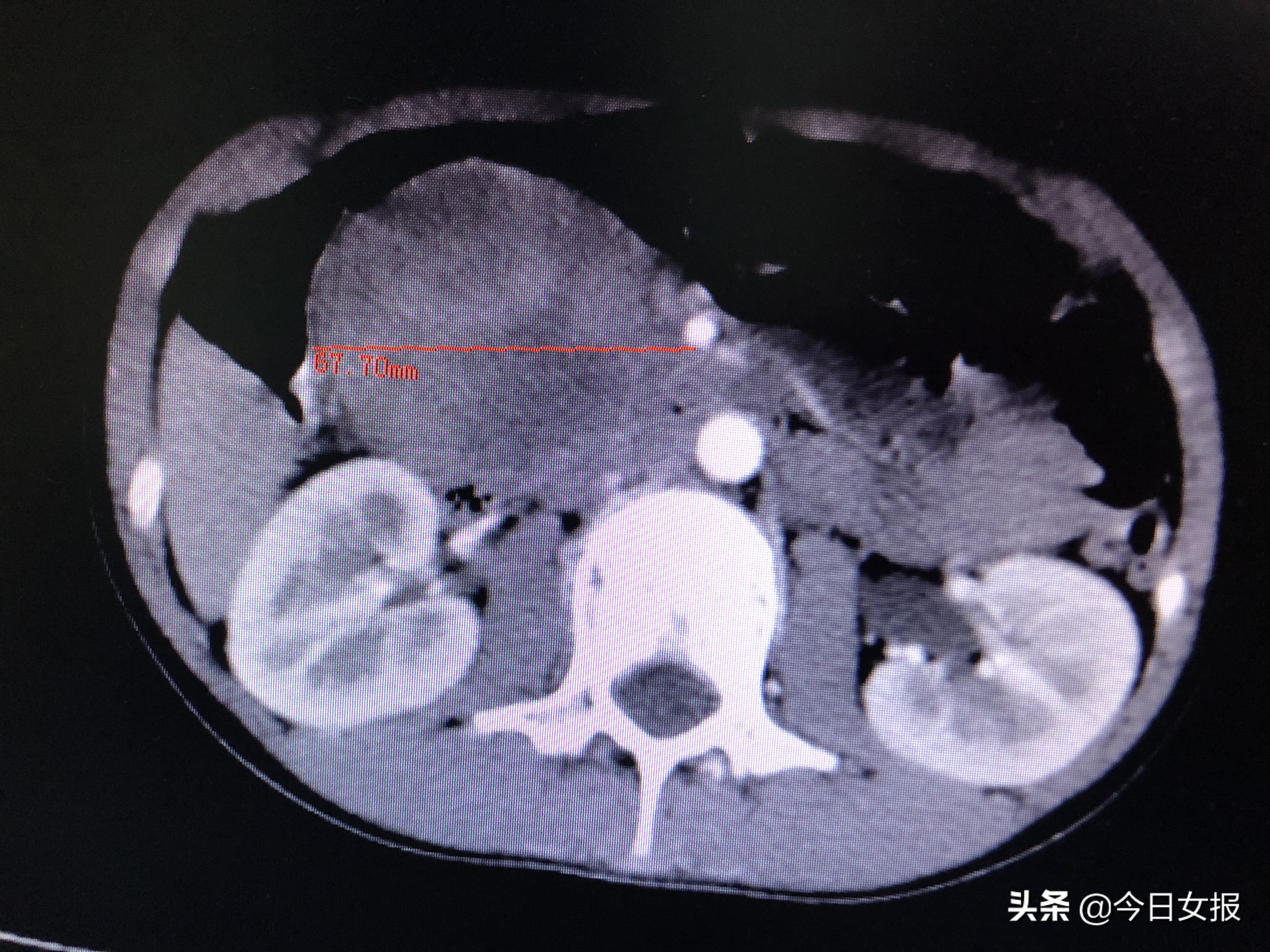 8岁小孩被同学踢中肚子后果,小女孩肚子被同学踢了一脚