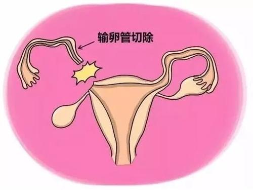 只有一侧输卵管怎么备孕快,宫外孕切除一侧输卵管后如何备孕