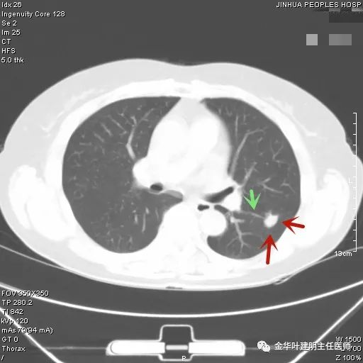 叶建明谈实性结节,叶建明肺实性良性结节会变癌症吗