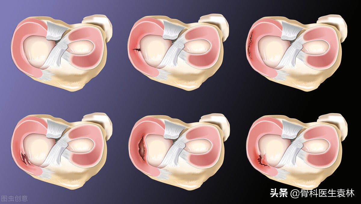 半月板撕裂缝合手术康复训练,半月板缝合手术需要多长时间能好