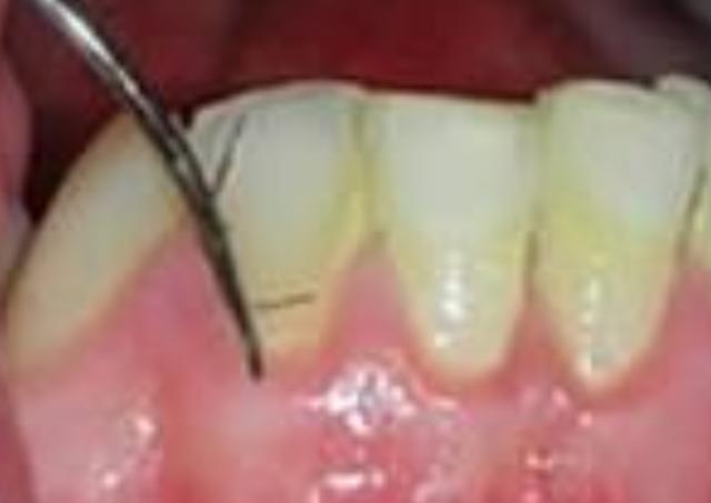 女孩牙龈罕见长出毛发，医生：之前都是男性