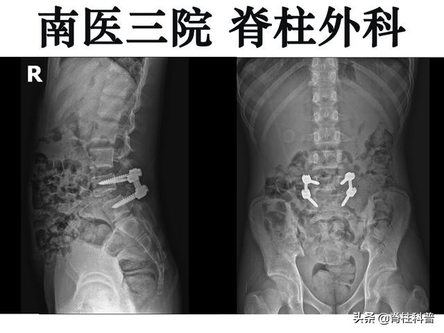 腰椎间盘突出怎样保养才不会复发,腰椎间盘突出症微创术后会复发吗