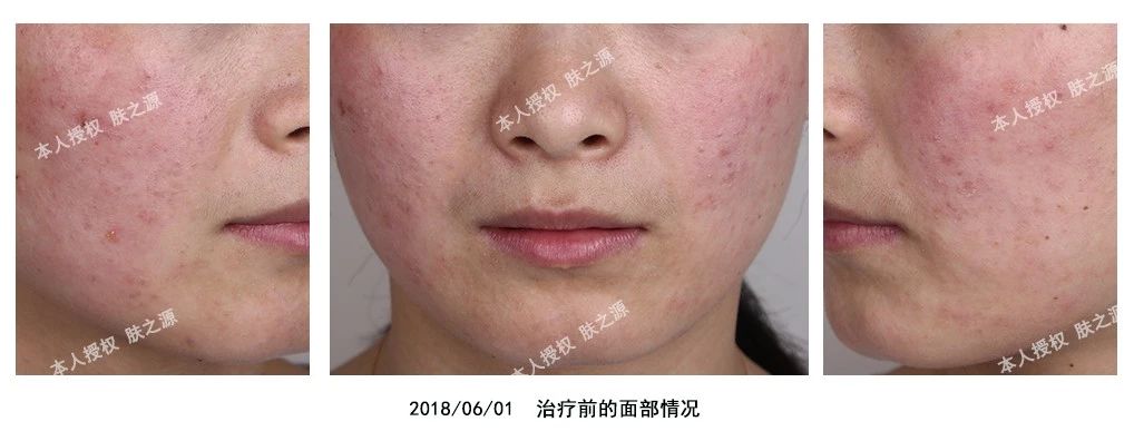 患者分享｜我的药物依赖合并玫瑰*疮痤**的治疗经历