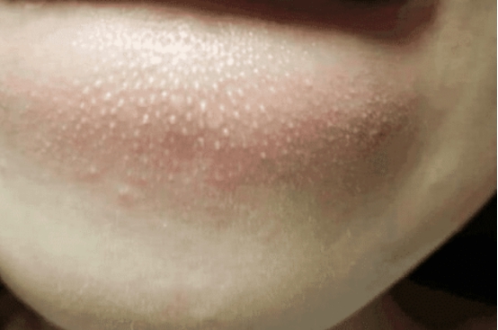 嘴巴抿起来有白色小颗粒怎么去除,抿嘴下巴颗粒怎么去除