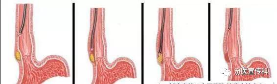 微创创伤恢复,胃肠微创手术恢复快吗