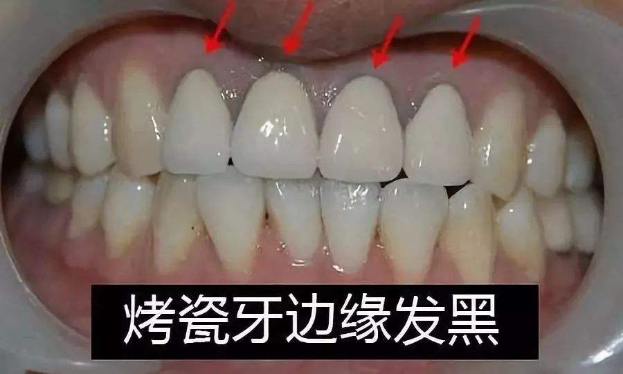 钴铬烤瓷牙边缘发黑,烤瓷牙根部发黑是什么原因