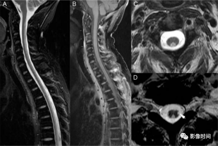 脊髓病变案例图文问诊,脊髓病变视频