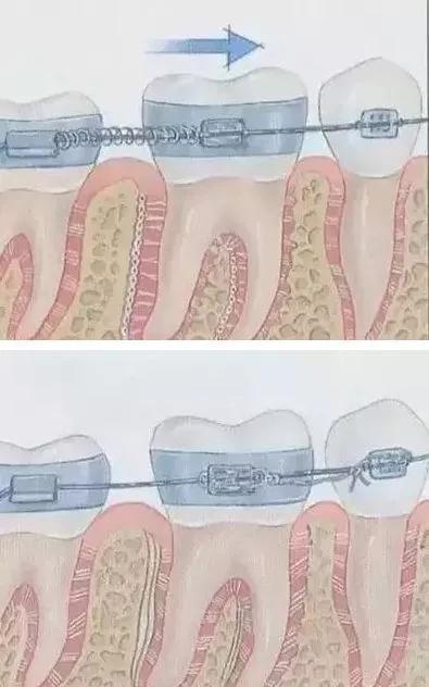 牙齿矫正必须先拔掉智齿嘛,牙齿矫正一定要先补牙吗
