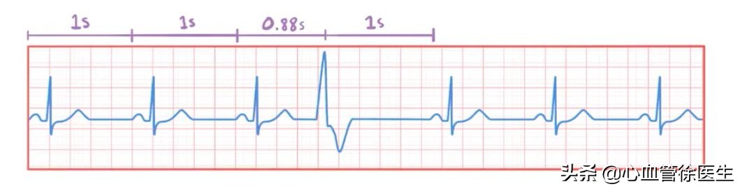 儿童心脏早搏是什么原因导致,导致心脏早搏的原因是什么