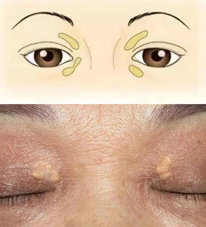 心脏引起的眼皮肿的图片,血汗管病人眼睛充血怎么回事