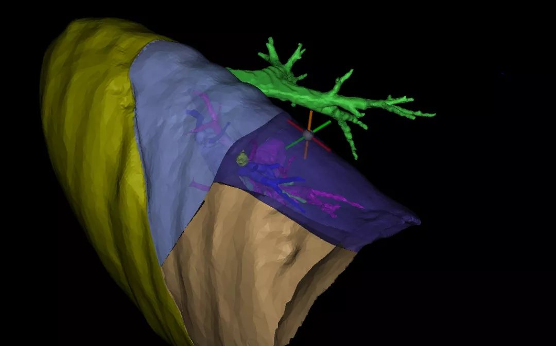 哈尔滨市肺磨玻璃结节权威医院,纳米机器人治疗肺结节