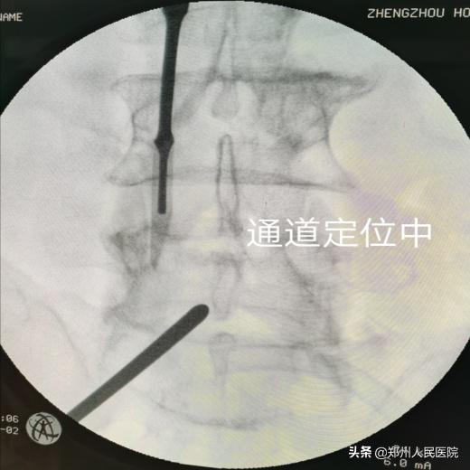 对骨科微创技术的认识,骨科手术与保守治疗对比