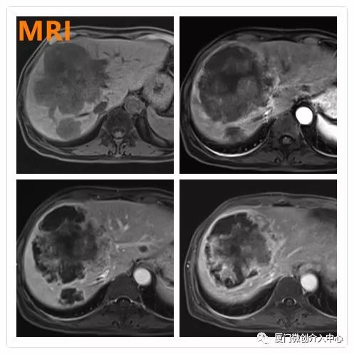 栓塞介入能治疗肝转移瘤吗,结肠癌肝转移介入栓塞治疗