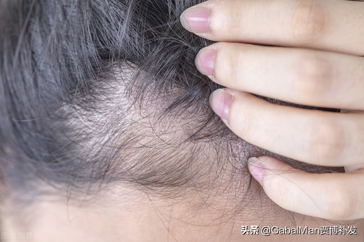 发际线到底该不该关注,发际线高怎么办怎么拯救发际线