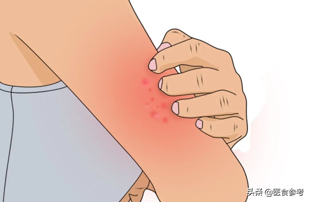 毒蚊子咬了肿起来怎么办,蚊子咬了一口怎么办