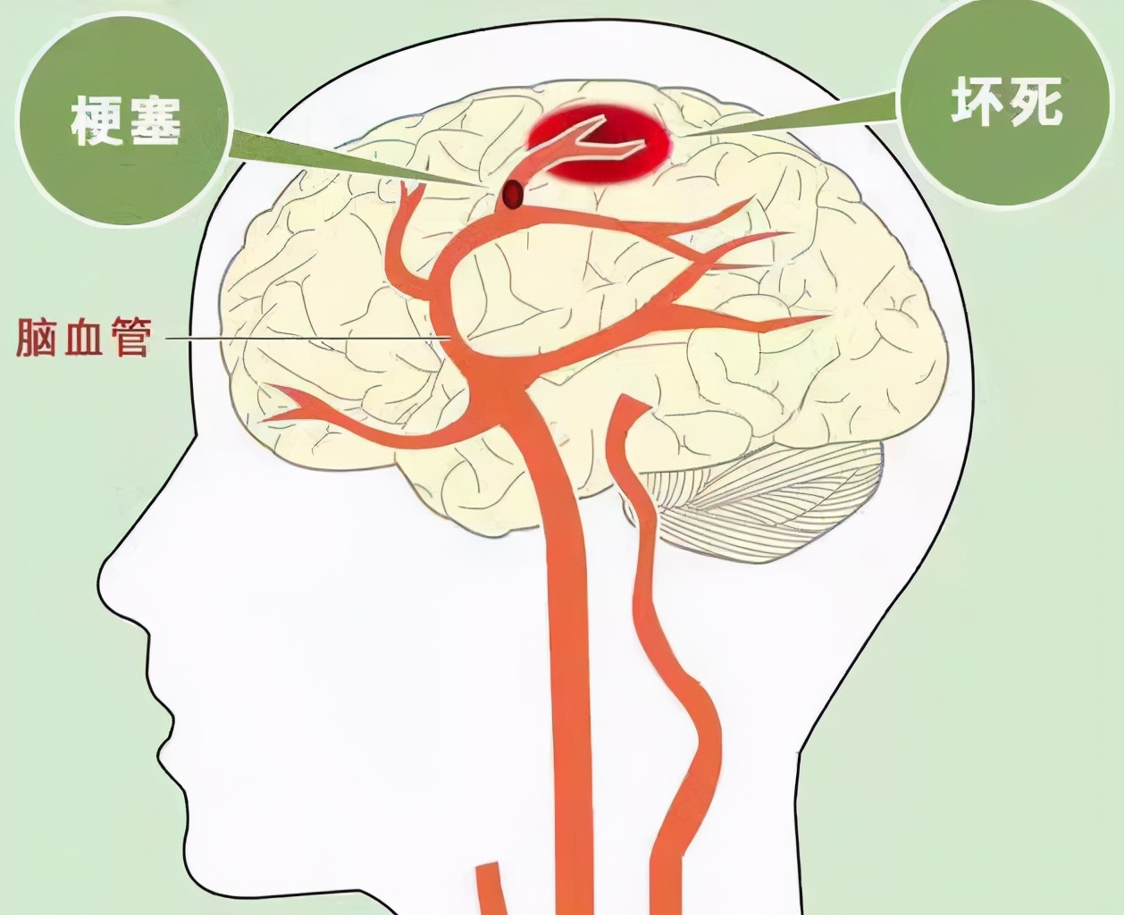 什么是脑梗有哪些症状,什么是脑梗脑梗塞需要关注什么