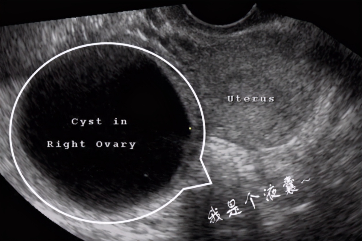 囊肿脓与淋巴脓的区别,液囊跟囊肿有什么区别