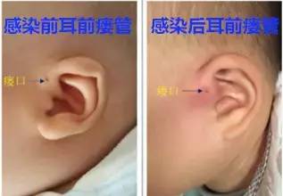 儿童掏耳朵冲洗耳道,耳鼻喉怎么给孩子掏耳屎