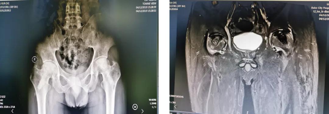 股骨头机器人手术微创,骨科机器人股骨颈手术