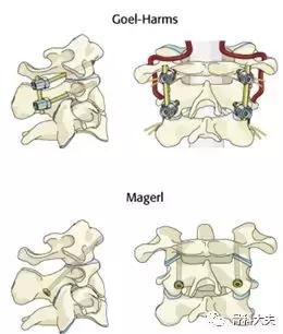 脖子突然往一边歪是怎么回事,孩子脖子突然歪了怎样矫正