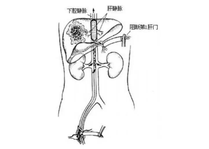 致敬吴孟超中国肝胆外科之父,中国肝胆外科之父吴孟超死