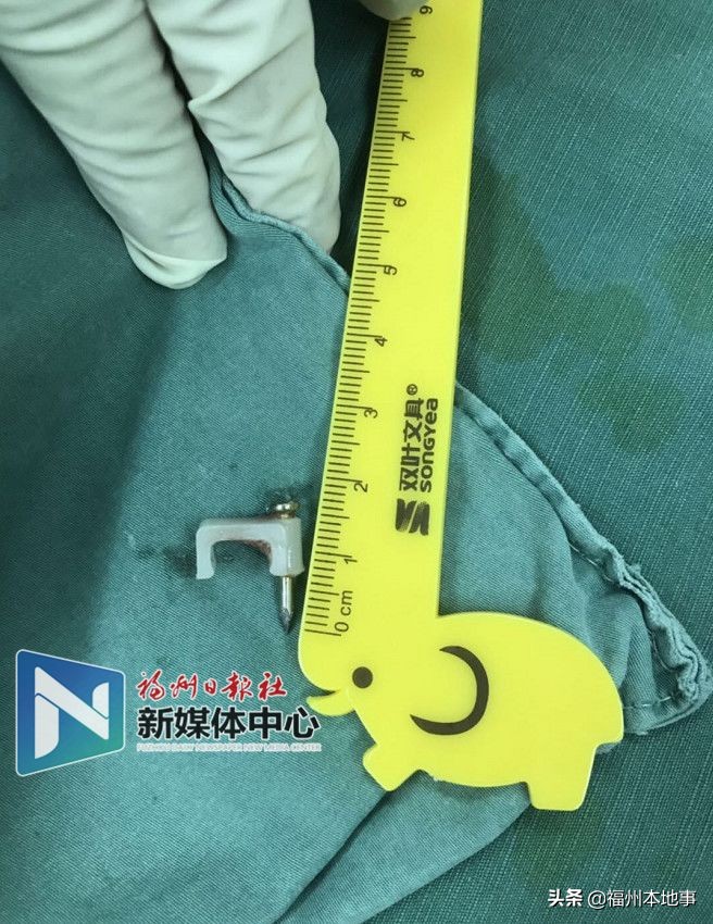 幼童误吞钉子,孩子误吞4厘米钉子