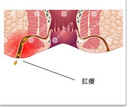 肛瘘肛周脓肿健康科普,健康科普肛周湿疹的鉴别诊断