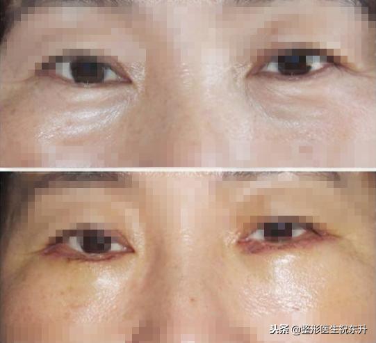 激光祛眼袋好还是手术去眼袋好,激光祛眼袋和手术哪个效果好