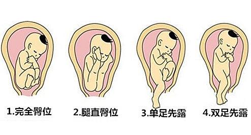 臀位孕妇应该怎么纠正,孕晚期臀位关注事项有哪些