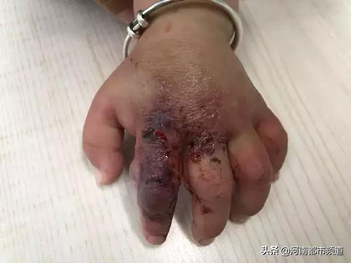 10个月大宝宝手背突然肿了,十个月宝宝手肿了怎么回事