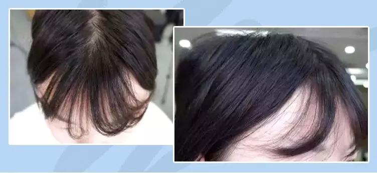 天天散着头发容易脱发吗,头发油了特别容易脱发