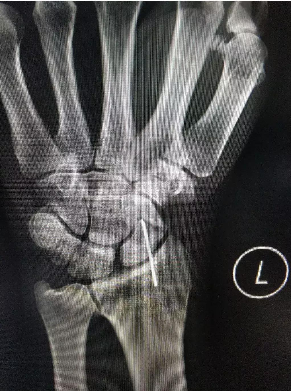 康复科的冲击波能频繁打吗,康复科体外冲击波