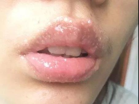 唇部纹绣后怎么护理,纹绣师自己漂唇第五天的效果