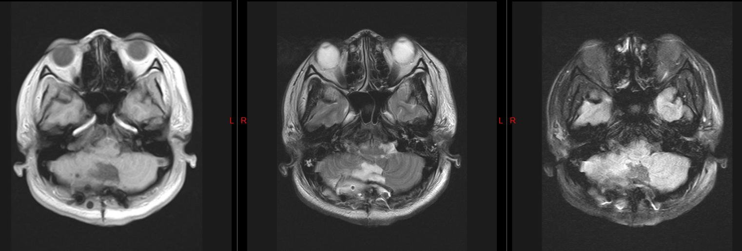 24岁脱发患者,24岁熬夜脱发