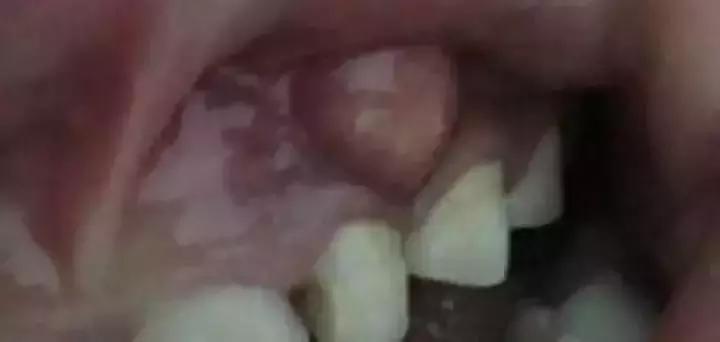 小黑点的蛀牙不严重吗,蛀牙了一点点黑色也得补么