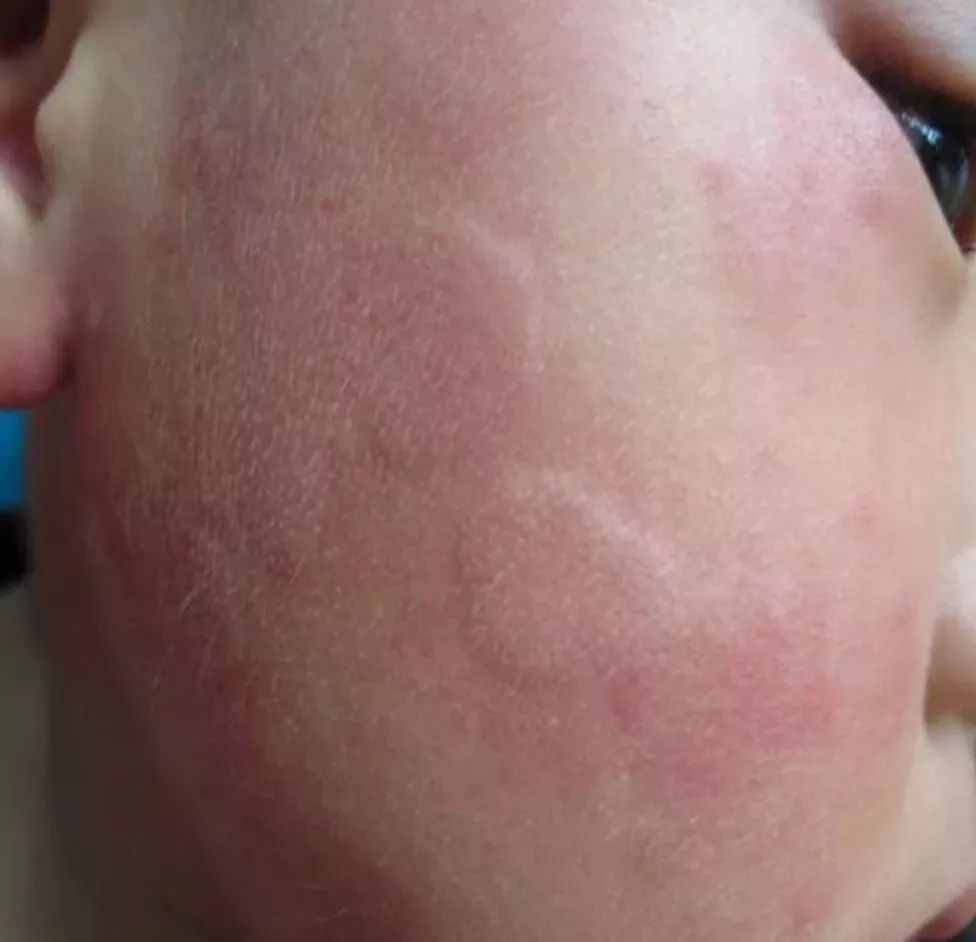 儿童春季常见疾病及治疗,当心这几类传染病近期高发