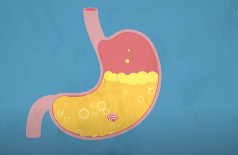 误食口香糖粘在喉咙,误食口香糖卡在肠胃里怎么办