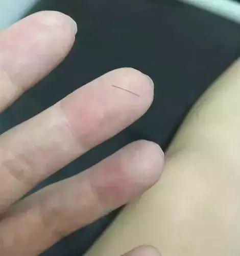谨慎！理发的头发碴扎进皮肤，他倒在手术台上